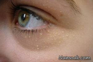 جوش های سفید ، چربی پوست