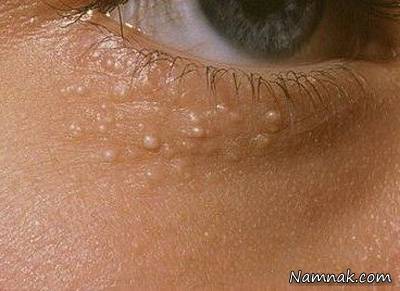 جوش های سفید اطراف چشم جوش های سفید