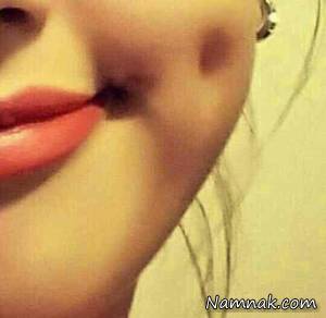 چال گونه ، چال خنده
