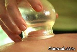 حجامت ، نکات بعد از حجامت