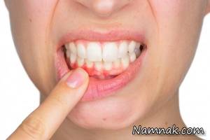 بیماری لثه ، بیماری لثه پیوره
