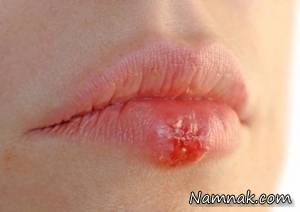 تبخال ، تبخال بینی