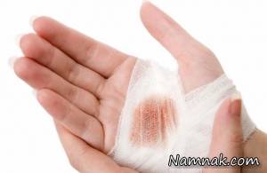 بتادین برای زخم ، ترمیم زخم بخیه
