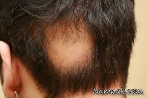 کچلی سکه ای ، کچلی سکه ای ریش