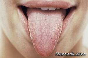 بیماری زبان ، علامت آلرژی روی زبان