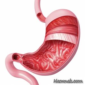 علائم زخم معده ، زخم معده