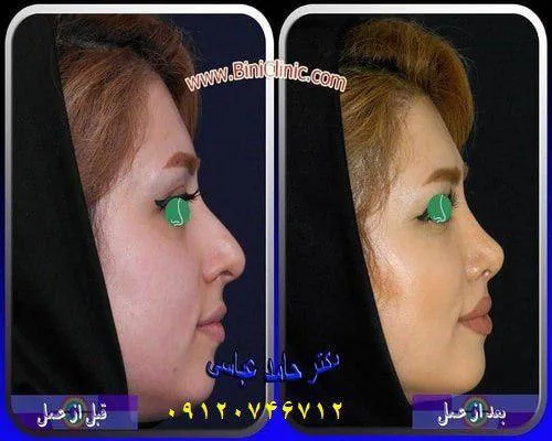 جراحی بینی استخوانی دکتر حامد عباسی جراح بینی
