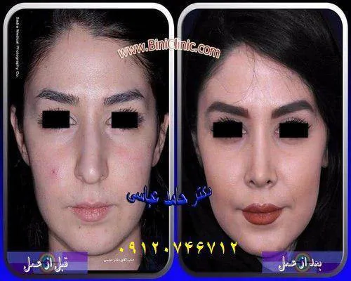 جراحی بینی گوشتی جراحی بینی استخوانی