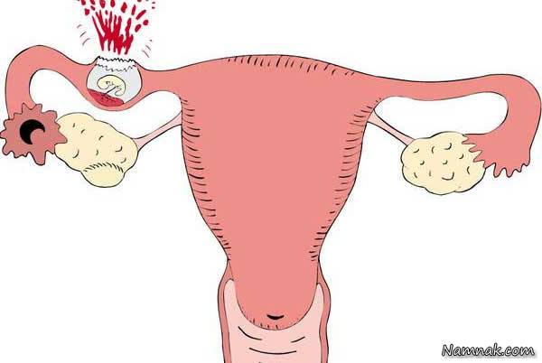علایم بارداری خارج از رحم چگونه است؟ جراحی بارداری خارج از رحم