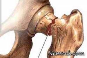 پوکی استخوان ، پوکی استخوان و تغذیه