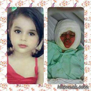 مرگ تلخ دختر بچه 3 ساله ، سوختگی درجه 2