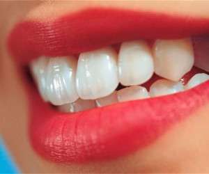 دندان سفید ، دندان+سفید کننده