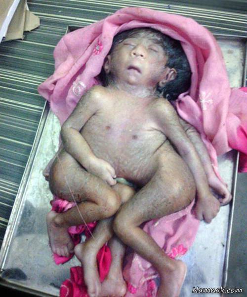 عکس های جنجالی از نوزاد عجیب الخلقه با 4 پا در هند