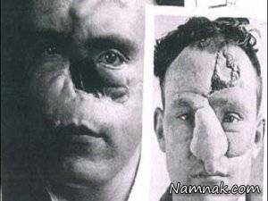 اولین کسی که دنیا بینی اش را جراحی کرد! + تصاویر