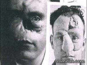 جراحی بینی ، جراحی