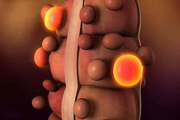 دیورتیکولیت روده دیورتیکولوز