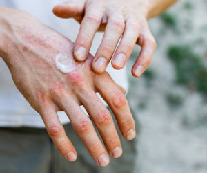عارضه های پوستی