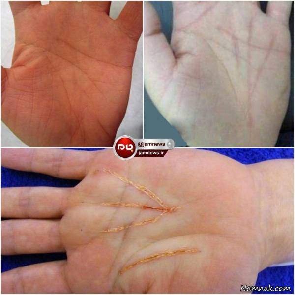 عمل جراحی خطوط دست برای تغییر سرنوشت!+ عکس عمل جراحی