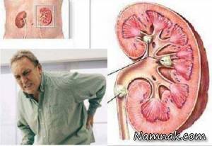 دفع سنگ کلیه ، سنگ کلیه چیست