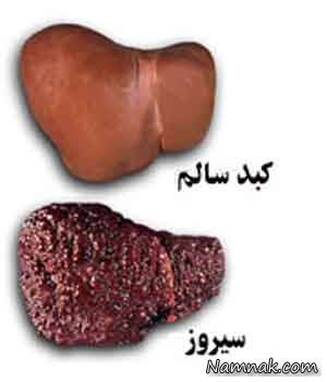 چگونه بفهمیم کبدمان خوب کار نمی کند؟ کار کبد