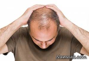 کچل شدن ، جلوگیری از کچل شدن ارثی
