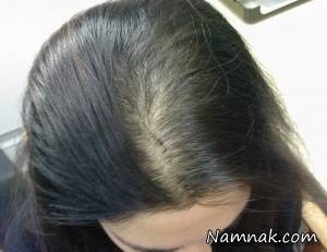 ریزش مو ، جلوگیری از ریزش مو
