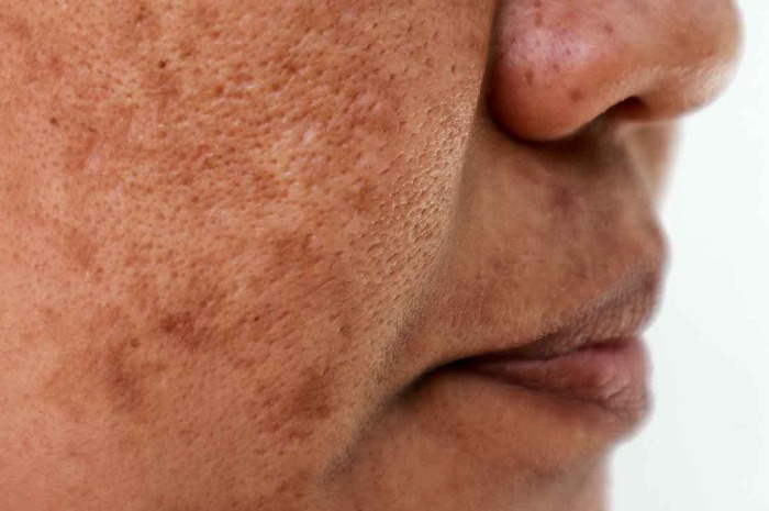 درمان لکههای قهوهای بعد از لیزر درمان لکههای قهوهای بعد از لیزر