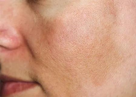 درمان لکههای قهوهای بعد از لیزر درمان لکههای قهوهای بعد از لیزر