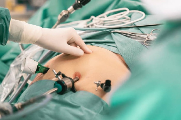 آیا جراحی های لاغری درمان قطعی چاقی است؟ عمل اسلیو معده