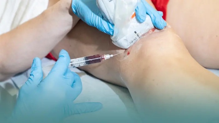 آیا چاقی باعث ابتلا به آرتروز میشود؟ درمان آرتروز با سلول بنیادی