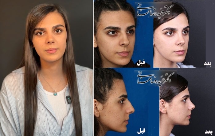۱۰ اشتباه رایج درباره عمل بینی که باید بدانید
