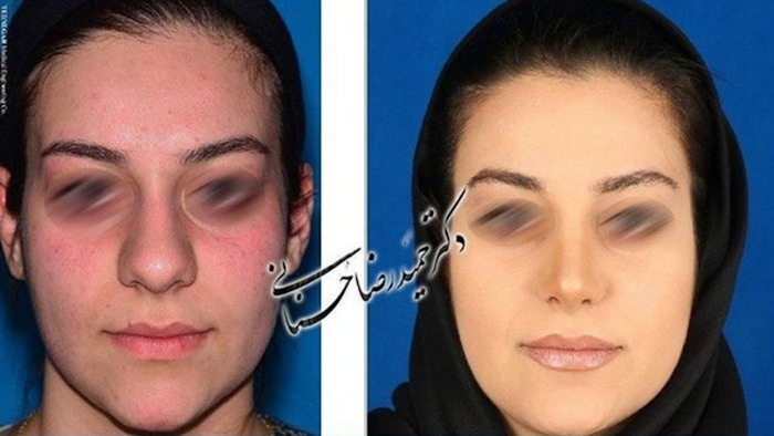 جراحی بینی گوشتی؛ نکاتی که قبل از عمل باید بدانید
