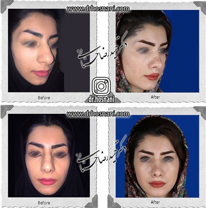جراحی بینی گوشتی؛ نکاتی که قبل از عمل باید بدانید