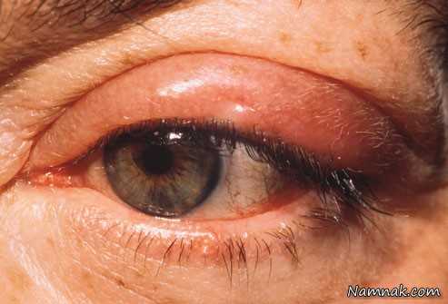 درمان جوش روی پلک چشم
