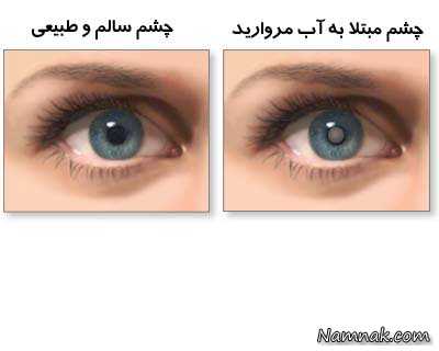 بیماری چشم