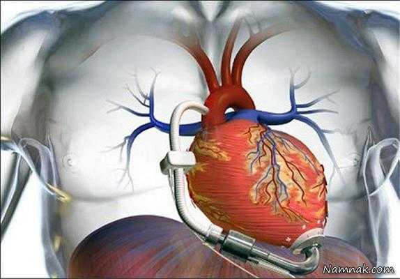 قلب مصنوعی ، ساخت قلب مصنوعی ، قلب مصنوعی با قابلیت پیوند