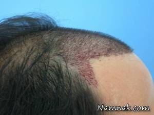 کاشت مو ، کاشت مو به روش fut