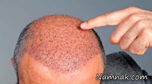 نحوه کاشت مو ، کاشت مو به روش fit