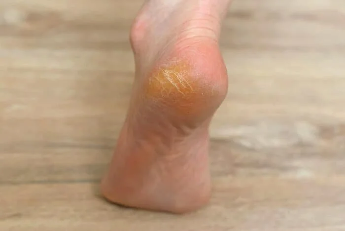 کمبود چه ویتامینی باعث ترک پا میشود؟ علت ترک پاشنه