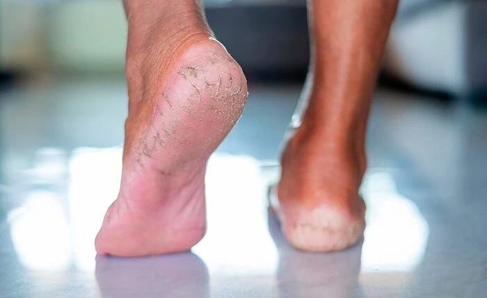 حمام داغ و ترک خوردن پاها عوارض آب داغ