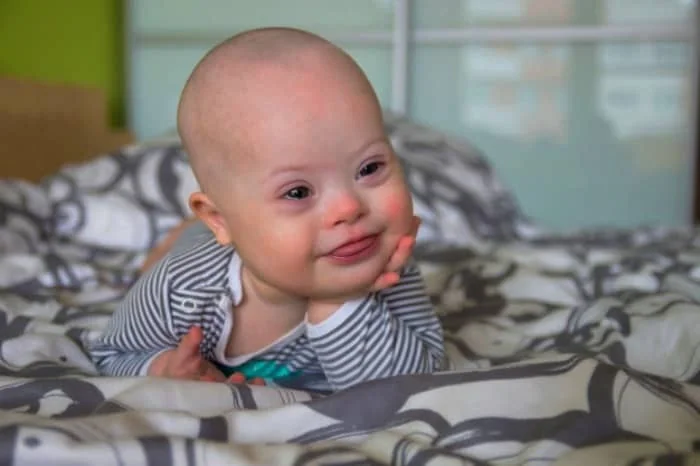 سندرم داون چیست؟ سندرم داون