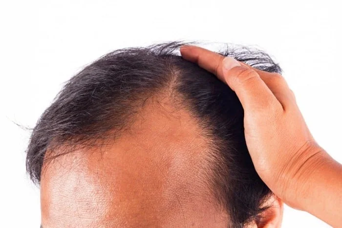 علل و درمان ریزش موی شقیقه ها ریزش موی شقیقه در زنان