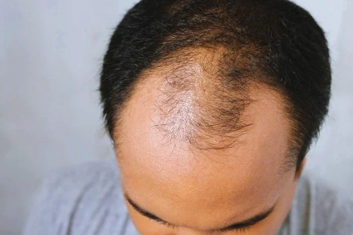 درمان ریزش مو در شقیقه ها علت ریزش مو در شقیقه ها