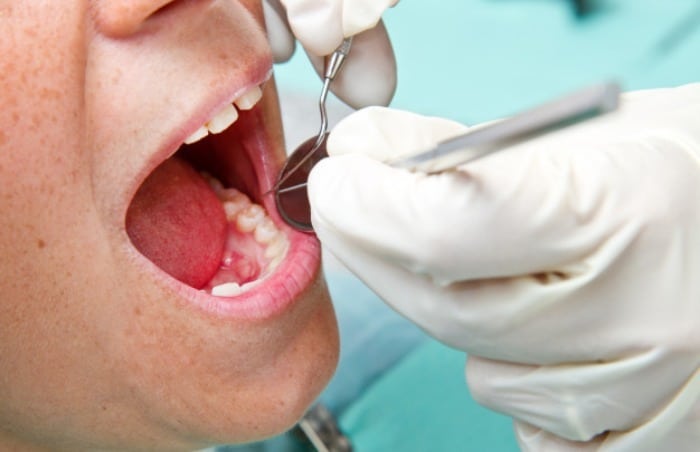 علت عصب کشی دندان