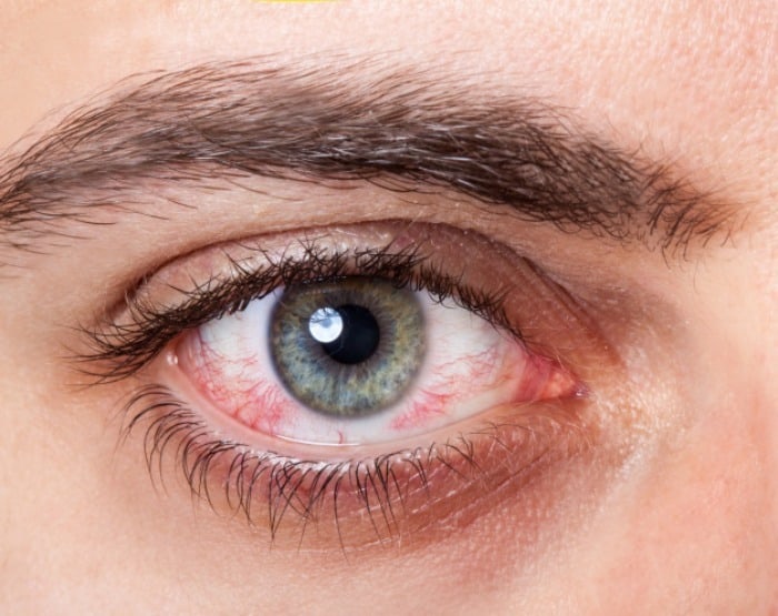 علت لکه خون در چشم