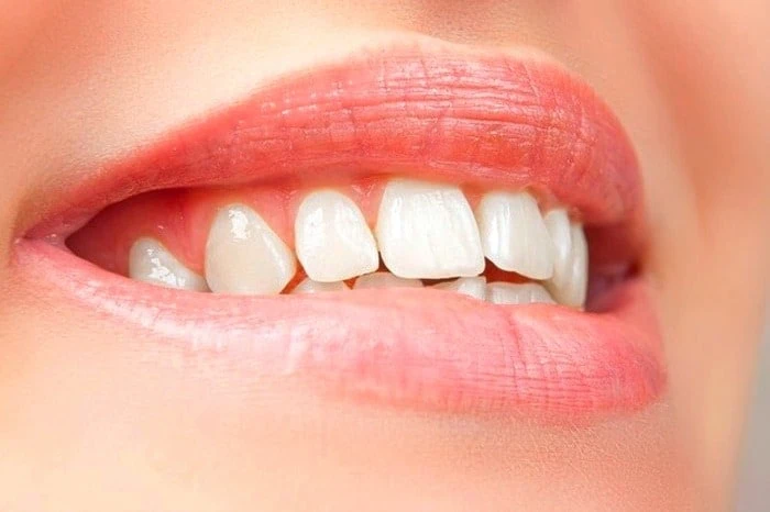 عوارض پریودنتال لثه چیست؟ علت بیماری پریودنتال