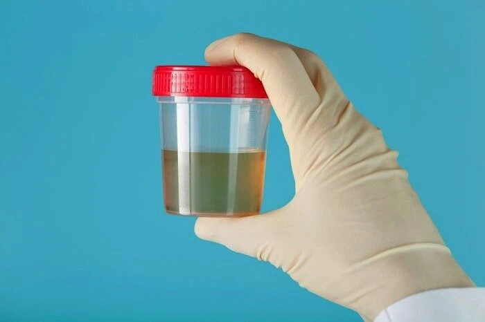 آزمایش دفع پروتئین در بارداری چگونه است؟ دفع پروتئین کم در بارداری