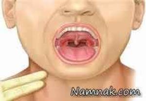 زبان کوچک ، متورم شدن زبان کوچک