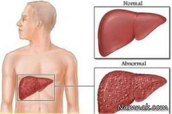 کبد چرب ، درمان کبد چرب ، علائم کبد چرب
