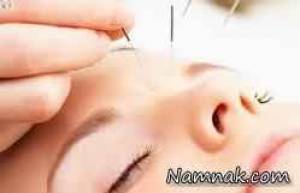 طب سوزنی ، طب سوزنی لاغری